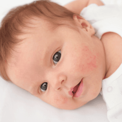 Baby with a mild rash on its cheeks.