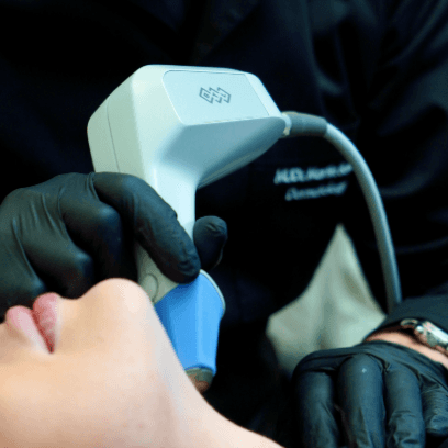 Dermatologist MUDr. Martin Bortlík performing a non‑invasive radiofrequency skin treatment in the lower jaw area using the Exilis Elite device.