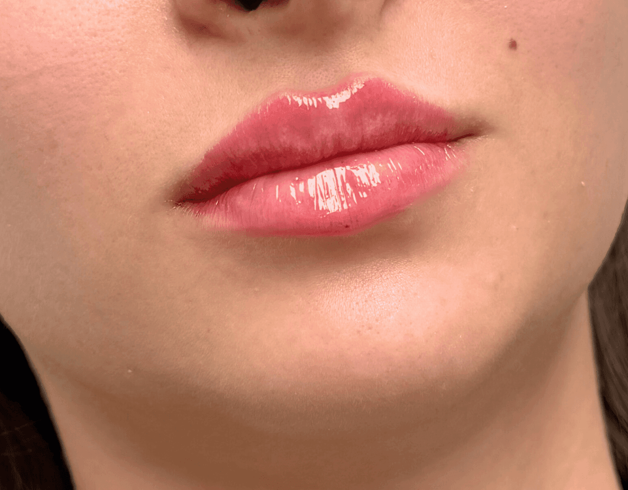 Close-up shot of a young woman’s lips after a HydraFacial treatment, emphasizing their natural shape.