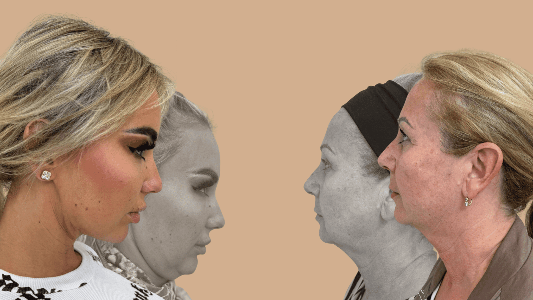 Collage of before‑and‑after photos of thread lifting – colored photos of women after the treatment with firmer and smoother skin on the sides, and a black‑and‑white image in the center showing the skin condition before the procedure.