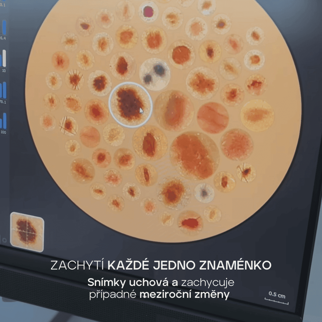 Detailní snímek počítačového monitoru zobrazujícího různá kožní znaménka zachycená kamerou přístroje IntelliStudio by Canfield. Text na obrázku říká: ‚Zachytí každé jedno znaménko. Snímky uchová a zachycuje případné meziroční změny.‘