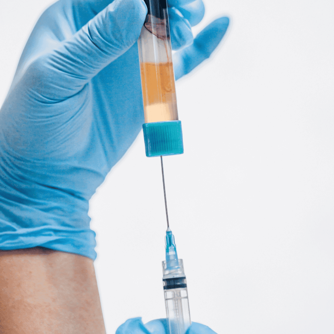 Příprava plazmy pro plazmaterapii – zdravotník v modrých rukavicích natahuje oddělenou krevní plazmu ze zkumavky do injekční stříkačky před její aplikací.