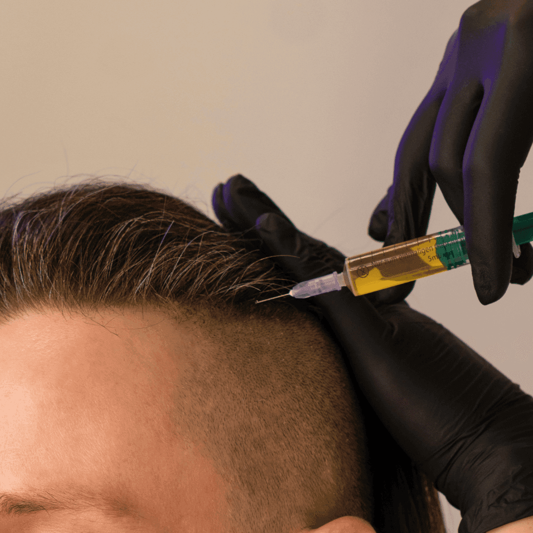 Odborník v černých rukavicích aplikuje injekci s plazmou do vlasové pokožky muže pro zlepšení hustoty vlasů.