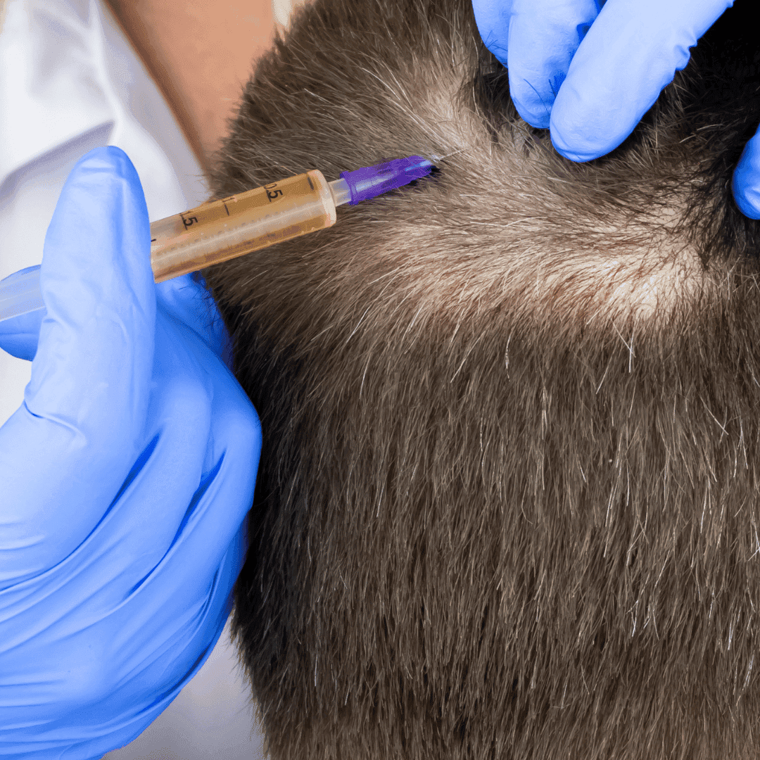 A medical professional in blue gloves injects the patient’s plasma into areas of thinning hair to support hair growth.