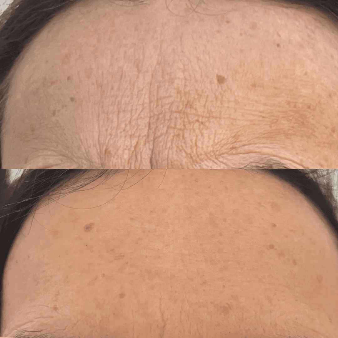 Fotografie ženského čela před a po ošetření botulotoxinem – horní část ukazuje čelo s vráskami a nerovnostmi pleti, dolní část zobrazuje hladší a jasnější pokožku po zákroku.