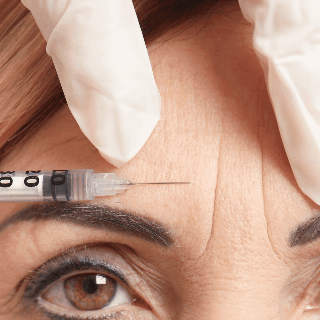 Close-up of a woman’s forehead with wrinkles, as a doctor wearing white gloves prepares to inject botulinum toxin.