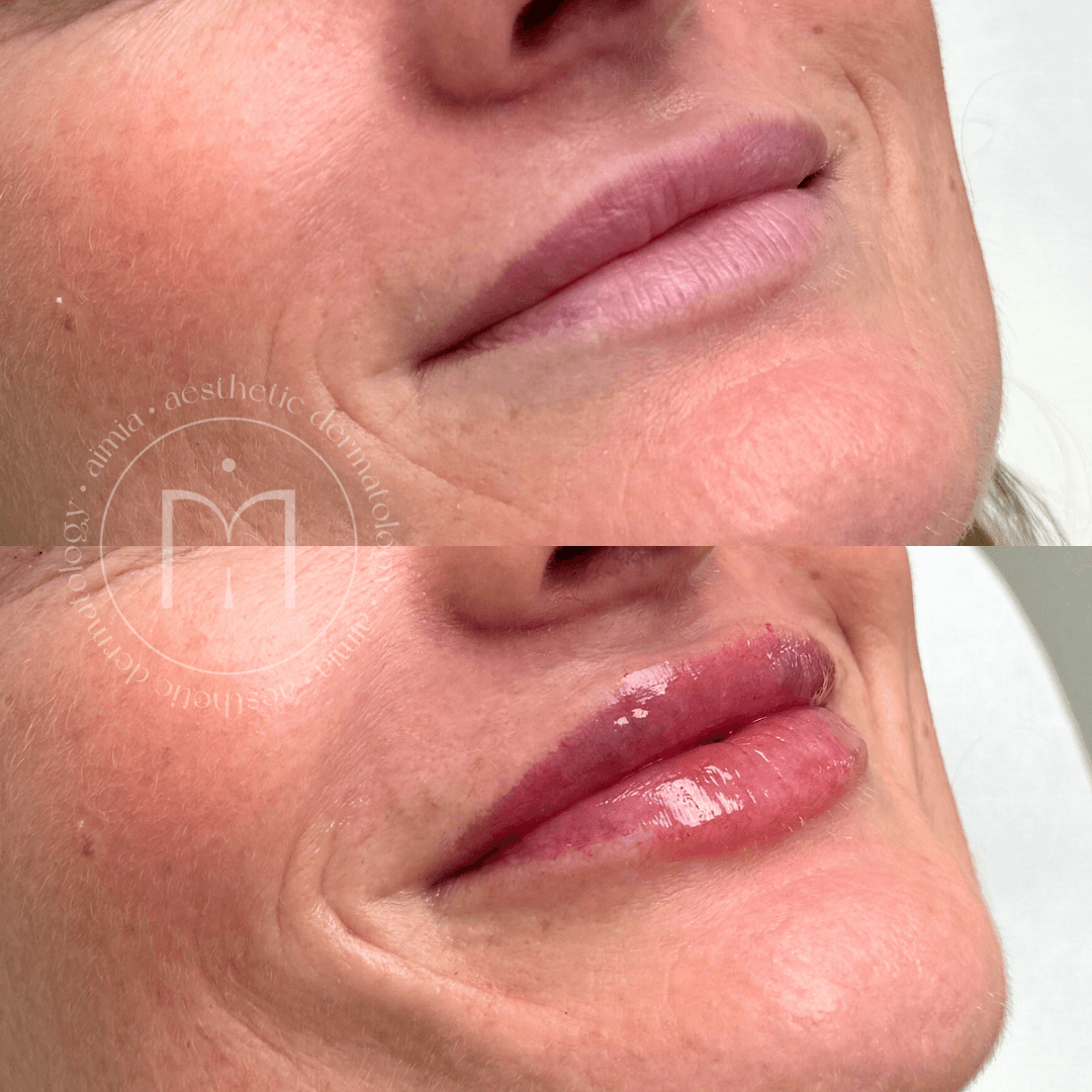 Srovnávací fotografie oblasti rtů ženy před a po ošetření výplně rtů – horní snímek ukazuje tenčí rty, zatímco dolní snímek zobrazuje plnější, hladší a lesklejší rty po ošetření.