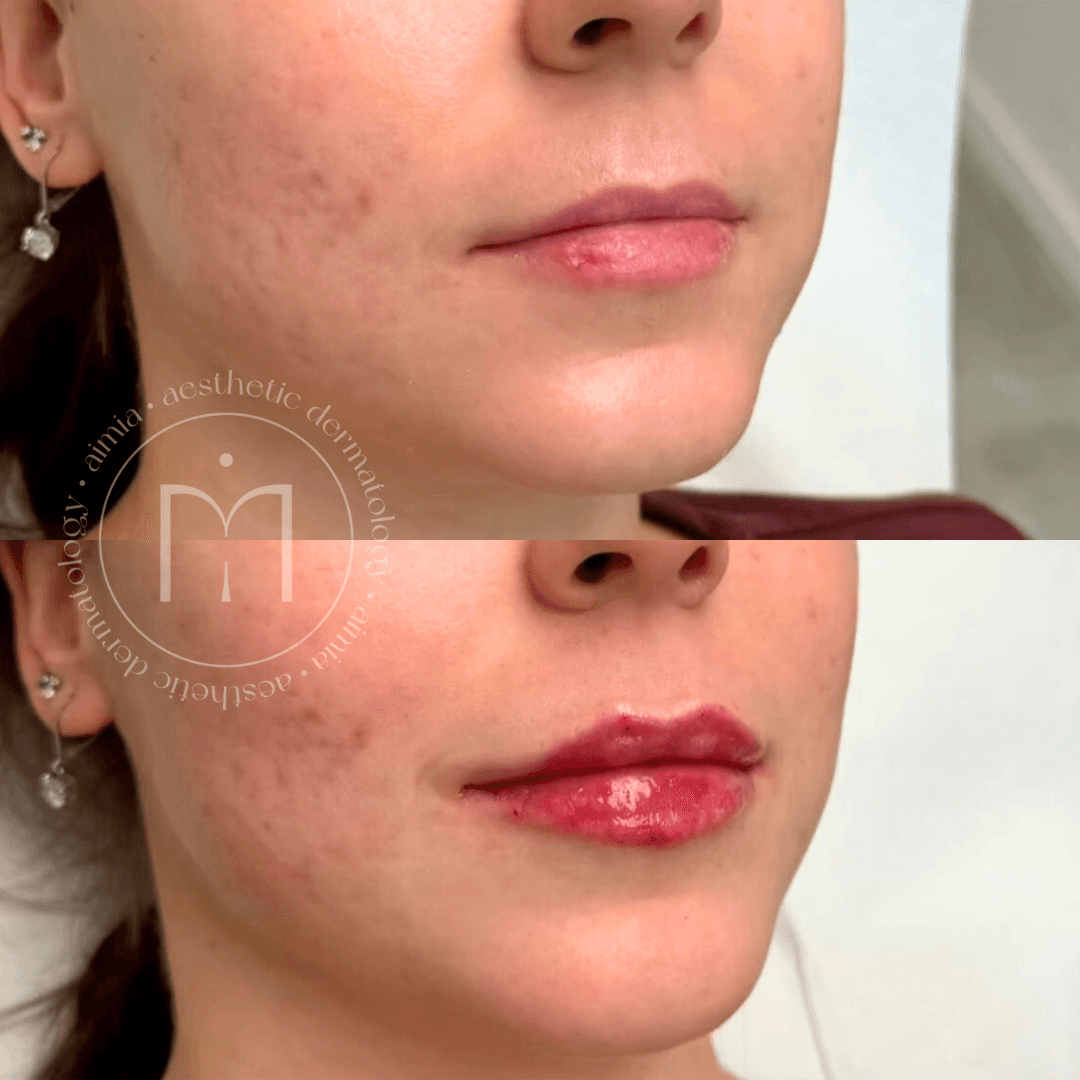 Srovnávací fotografie dolní části obličeje ženy před a po ošetření výplně rtů – horní snímek ukazuje tenčí rty, zatímco dolní snímek zobrazuje plnější, lesklejší a výrazněji tvarované rty po ošetření.