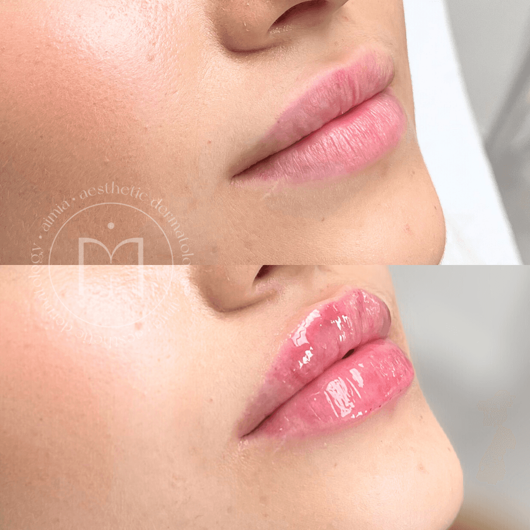 Comparison photo of lips before and after lip filler treatment – the top image shows less pronounced lips, while the bottom image shows fuller and shinier lips after the procedure.